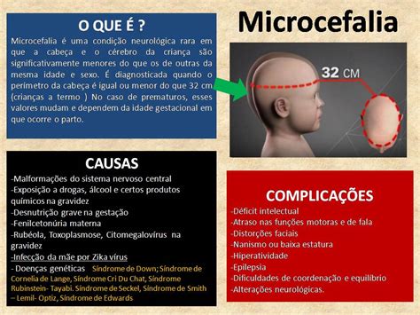 microcefalia o que é